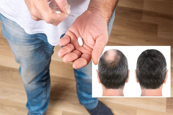 چرا موها می‌ریزند؟ (نقش کمبود ریزمغذی‌ها در سلامت فولیکول مو)
